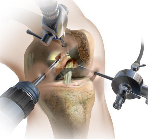 Как проходит артроскопия тазобедренного сустава.